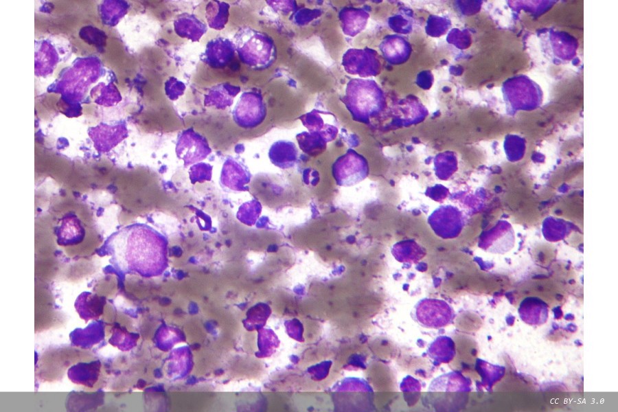 Blood samples enhance B-cell lymphoma diagnostics and prognosis
