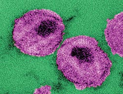 Aggressive form of HIV uncovered in Cuba
