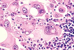 To kill melanoma cells