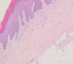 Reducing formalin exposure risks in the management of surgical specimens