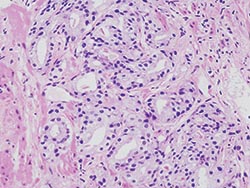 Testing times for prostate cancer