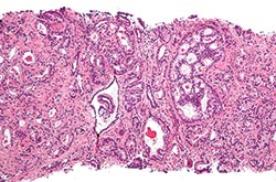 Improved prostate cancer screening