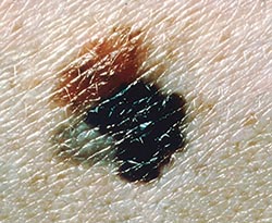Early warning of skin cancer relapse