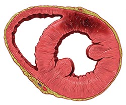 Myocardial infarction: improved detection in women