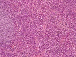 T-cell therapy for synovial sarcoma