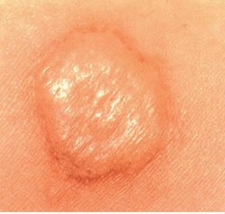 Interferon-gamma assays: role in the diagnosis of M. tuberculosis infection