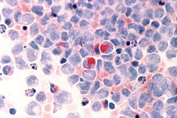 Making sense of big data: studying leukaemia in the USA and Sweden
