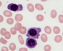 Helping to find the best treatment for multiple myeloma