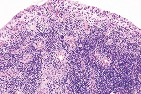 Rheumatoid arthritis: the role of serology in laboratory diagnosis