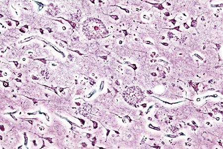 Designer protein aids study of Alzheimer’s disease