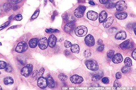 Over-diagnosis of thyroid cancer
