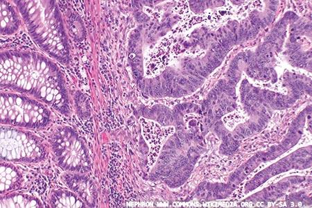 Faecal immunochemical testing: a new pathway for bowel cancer patients