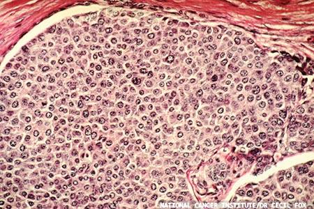 New tests for breast cancer drugs