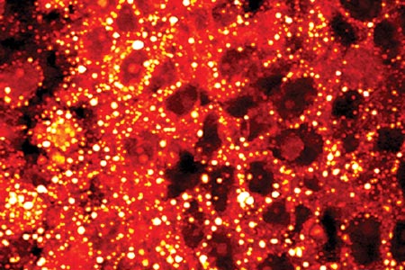 Circulating prostate cancer cells: predicting metastasis