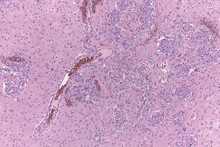 Genetic biomarker for glioma 