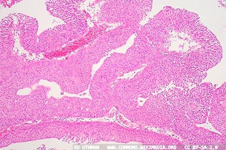 Evaluating ELISA-based urine test for bladder cancer