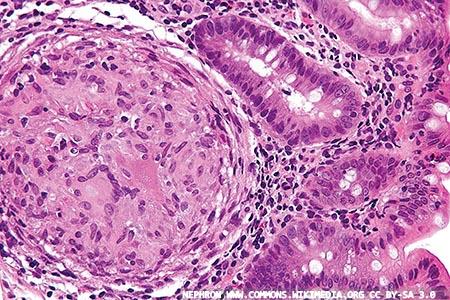 Anti-tumour necrosis factor drug levels and neutralising antibodies: an update 