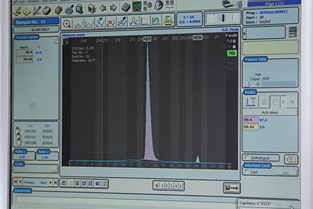 Haemoglobinopathies: screening using capillary electrophoresis 