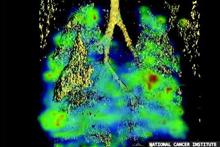 Detecting gene mutations in lung cancer