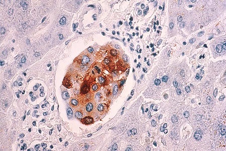 New blood test for breast cancer patients