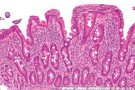Coeliac disease: boosting research efforts