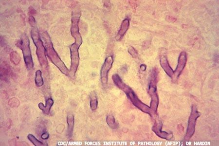 Pre-emptively treating  invasive aspergillosis:  rapid diagnosis by PCR