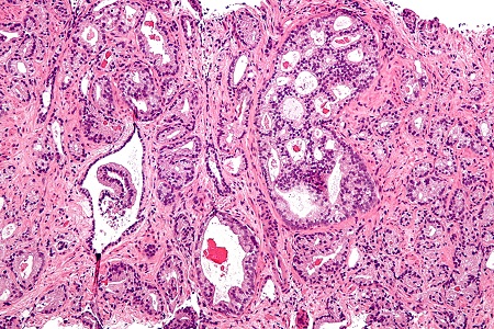 Biomarker test for high-grade prostate cancer could avoid need for biopsy 