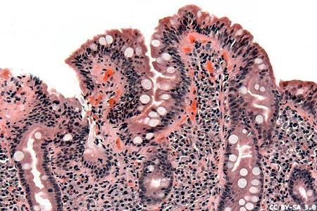 Research shows a rise in coeliac disease diagnosis 