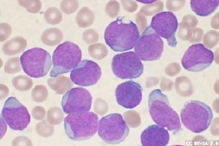 Chimaeric antigen receptor T cell therapy receives EU regulatory approval
