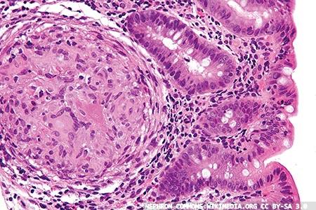 Calprotectin and elastase:  update on faecal testing for  gastrointestinal diseases