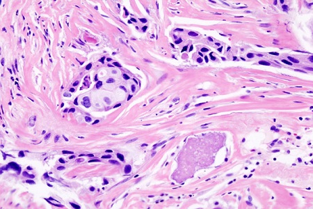Government and Philips consortium co-invest in digital pathology and AI to improve cancer care in the UK