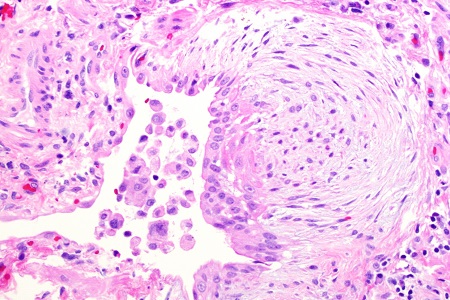 Dual-action cancer-killing virus: early tests 