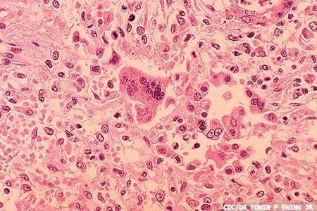 Measles: the importance  of vaccination, disease  monitoring and surveillance