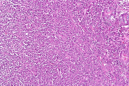 Rare Disease Collaborative Network on refractory coeliac disease commissioned