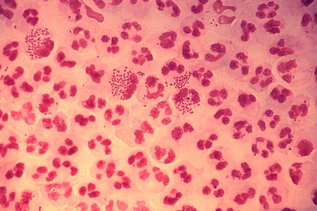 Gonorrhoea and antimicrobial resistance