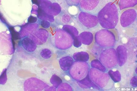 Childhood leukaemia distinct from adult disease