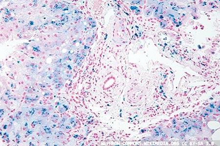 Hepcidin: an interesting journey from bench to  bedside and beyond