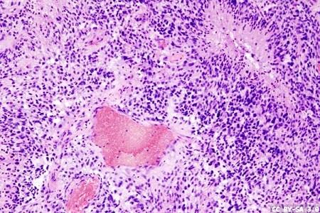 Specific Gene Mutations predict Success of glioblastoma immunotherapy