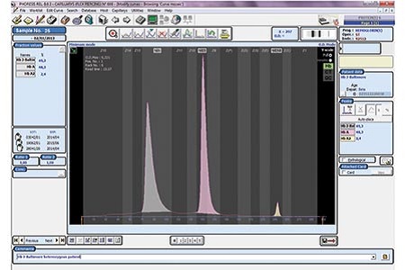 Evolution of capillary electrophoresis: disease diagnosis and monitoring