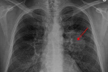 First in vitro diagnostic test to target ROS1-positive lung cancers