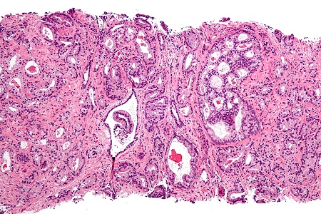Urine test for prostate cancer; a genetic approach