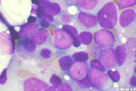 Natural killer cells and relapsed/refractory acute myeloid leukaemia