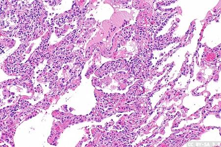 Squalene-based nanoparticles in the treatment of septic shock and uncontrolled inflammation