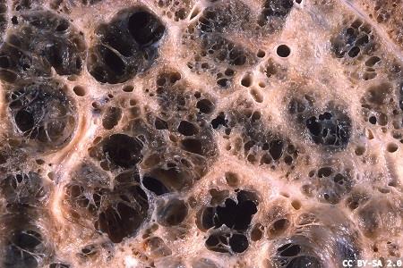 Non-tuberculous mycobacteria: new digital educational resource 