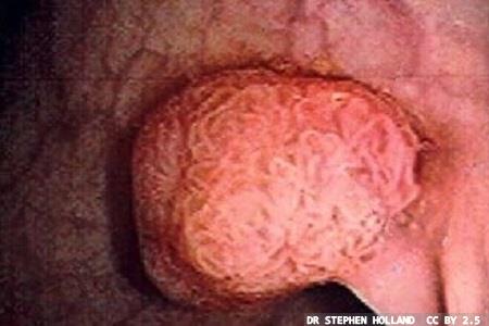 Transforming bowel cancer screening into a precision tool using AI