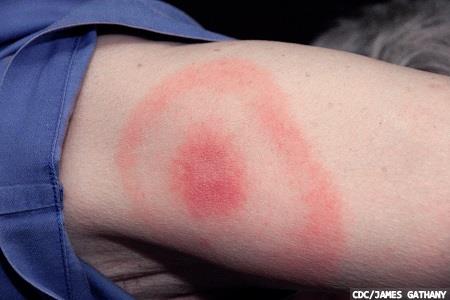 Lyme disease testing: a free webinar