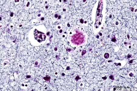 Differences in biomarkers and genetic risk of Alzheimer’s disease
