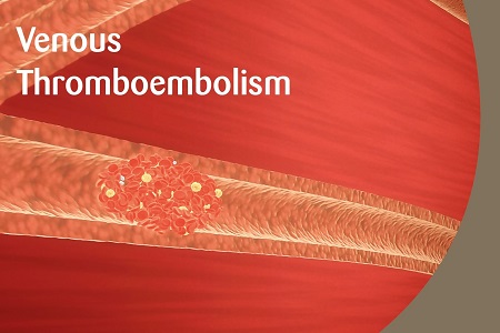 Practical manual guide on venous thromboembolism 