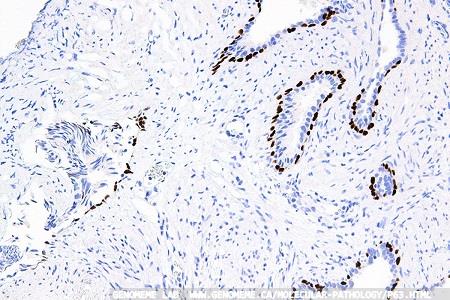 Improving cancer diagnostics with AI in pathology