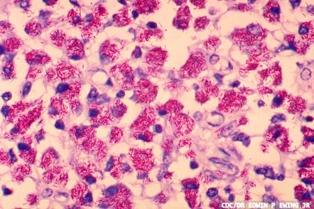 Non-tuberculous mycobacterial pulmonary disease
